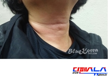 학생들에게 목을 맞아 목이 부어오른 엄마부대 봉사단 회원. 언론은 '엄마부대봉사단' 주옥순 대표가 학생들을 폭행했다고 보도하였으나, 경찰은 '무혐의' 처리하였다. 반대로 학생들은 엄마부대봉사단 회원들에게 입에 담지 못할 욕설을 퍼부으면서 멱살을 잡는 등 행위를 하였다. (사진 = 주동식 뉴스인포토 대표)